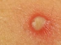 Remédios caseiros para tratar furúnculo