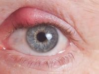 Terçol: o que é, como tratar e prevenir