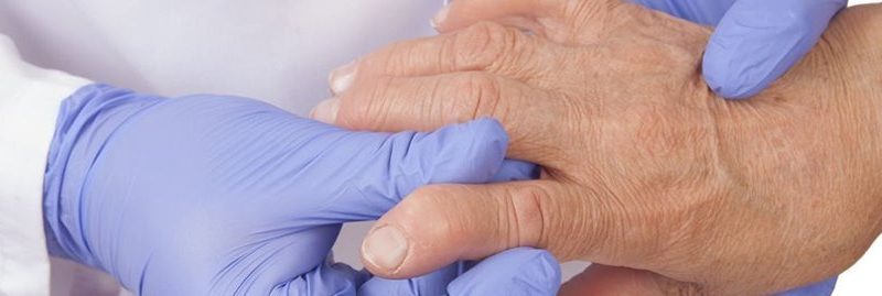 Remédios naturais para tratar a artrite reumatoide