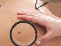 Como identificar o câncer de pele