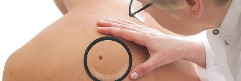 Como identificar o câncer de pele