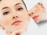 Remédios caseiros para cicatrizes de acne