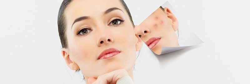 Remédios caseiros para cicatrizes de acne