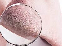 Remédios caseiros para pés rachados e ressecados