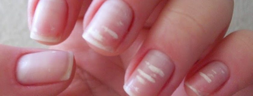 9 sinais corporais que podem indicar deficiências nutricionais
