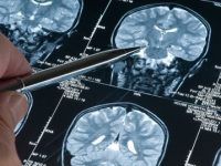 10 coisas que você deve saber sobre a doença de Alzheimer