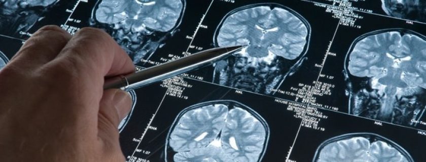 10 coisas que você deve saber sobre a doença de Alzheimer