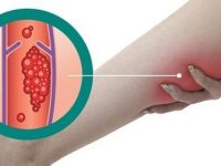 7 melhores remédios caseiros para trombose venosa profunda