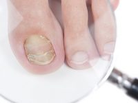 8 remédios caseiros para tratar micose de unha rapidamente