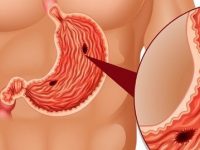 10 causas mais comuns para úlcera no estômago