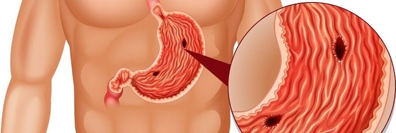 10 causas mais comuns para úlcera no estômago