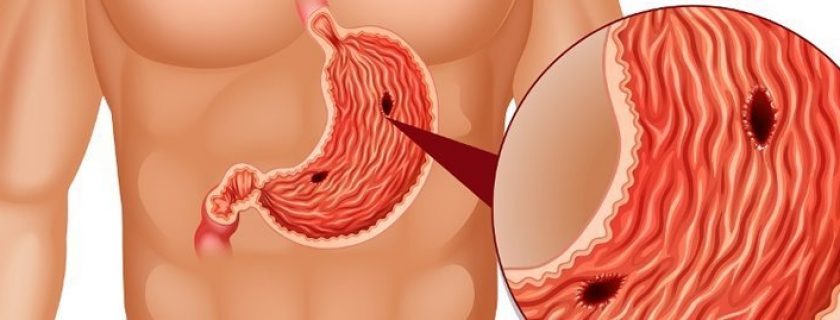 10 causas mais comuns para úlcera no estômago