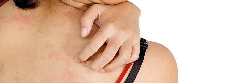 10 melhores remédios caseiros para tratar eczema