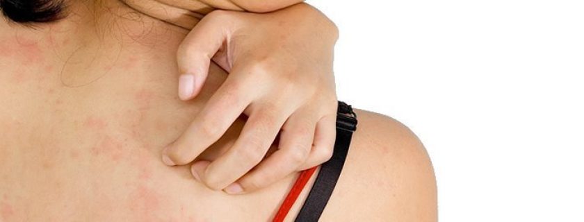 10 melhores remédios caseiros para tratar eczema