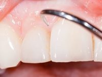 8 incríveis remédios caseiros para gengiva retraída