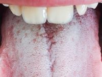 Língua branca: causas e remédios caseiros para tratar o problema