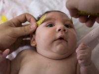 O que é microcefalia e quais suas consequências ao bebê