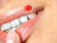 O que é o herpes e como tratá-lo em diferentes áreas do corpo