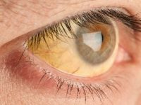 O que é icterícia e como tratá-la em adultos e crianças