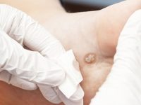 O que é olho de peixe e como removê-lo com remédios caseiros