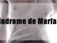 O que é Síndrome de Marfan e como tratar seus sintomas