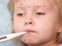 O que é escarlatina e como tratar seus sintomas corretamente