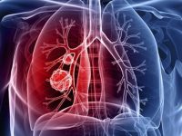 Enfisema pulmonar tem cura? Conheça seus sintomas e tratamentos