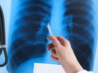 O que é atelectasia pulmonar, quais seus sintomas e tratamento?