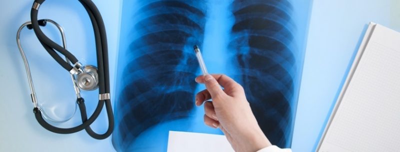 O que é atelectasia pulmonar, quais seus sintomas e tratamento?