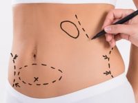 O que é abdominoplastia, qual seu valor e seus riscos?