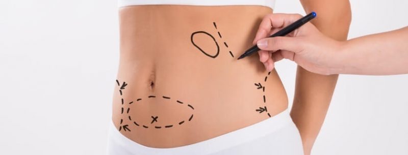 O que é abdominoplastia, qual seu valor e seus riscos?
