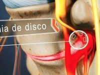 O que é hérnia de disco, quais seus sintomas e tratamentos?
