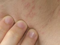 O que é impingem, causas, sintomas e melhores tratamentos