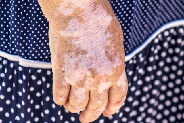 Vitiligo Tem Cura? Saiba O Que é, Suas Causas, Sintomas E Tratamento