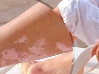 Vitiligo tem cura? Saiba o que é, suas causas, sintomas e tratamento