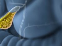 O que causa pedra na vesícula, quais seus sintomas e tratamentos?