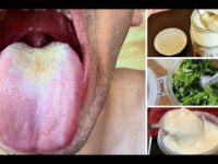 10 remédios caseiros simples e eficazes para curar afta rápido