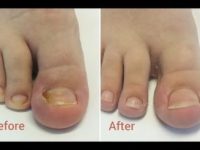 3 remédios caseiros simples e eficazes para tratar unha encravada