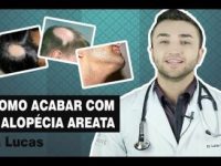 Alopécia Areata: como tratar esse problema de forma eficaz?