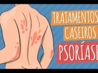 Dicas de alimentação e tratamentos para a psoríase