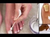 Incríveis remédios caseiros para tratar fungo na unha