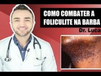 Maneiras simples de evitar e tratar a foliculite na barba