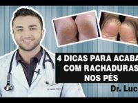 Pés rachados: 5 dicas para acabar com esse problema