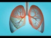 Saiba o que é enfisema pulmonar e conheça as válvulas brônquicas unidirecionais