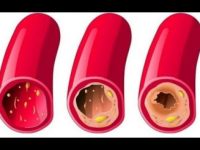 Super remédio caseiro para limpar veias e artérias naturalmente