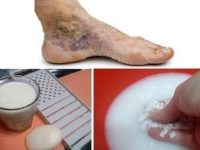 Varizes: os melhores remédios caseiros para tratar o problema